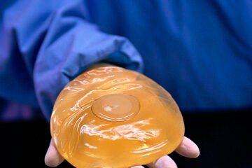Sanidad confirma 102 casos de un raro linfoma asociado a implantes de mama