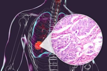 Las muertes por cáncer de pulmón en mujeres en España superan por primera vez a las de cáncer de mama
