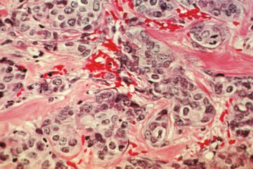 Un medicamento experimental logra reducir tumores metastásicos en seis pacientes y que desaparezca el cáncer en dos