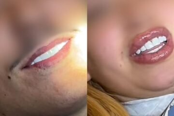 Carillas, vuelos y alojamiento por 1.250 euros: así funciona el turismo dental en Marruecos que advierten los dentistas españoles
