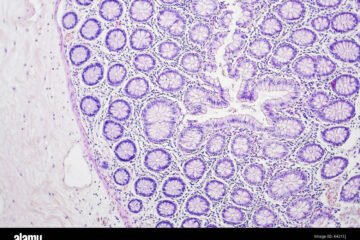 Una vacuna demuestra eficacia para prevenir el cáncer de colon en un ensayo clínico