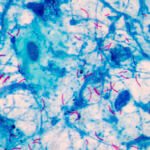 Europa no detecta uno de cada cinco casos de tuberculosis