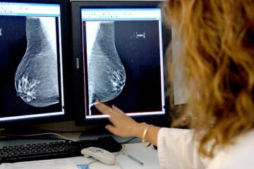 Sanidad aprueba la ampliación del cribado de cáncer de mama a mujeres de entre 45 y 74 años