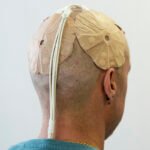 La estrategia experimental que prueba Pablo contra el tumor cerebral más agresivo