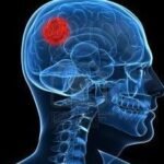 El glioma de bajo grado provoca una pérdida de productividad de más de 16.000 euros por cada paciente y familiar al año