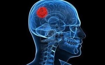El glioma de bajo grado provoca una pérdida de productividad de más de 16.000 euros por cada paciente y familiar al año