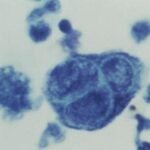 La nueva vacuna del herpes zóster reduce en casi un 90% los casos de la enfermedad entre mayores de 80 años